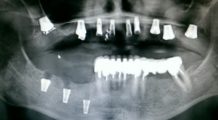 Как понять, прижился ли имплант зуба?