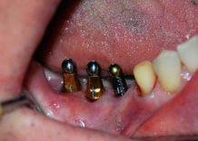 История и виды зубных имплантов