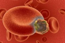 Анализ крови при онкологии крови (лейкоз)
