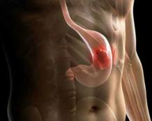 Перстневидноклеточный рак желудка