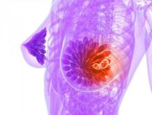 Рак молочной железы 4 стадии