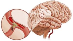 Атеросклероз сосудов головного мозга: как лечить