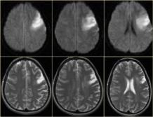 Ишемия головного мозга — лечение народными средствами