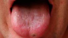 Сифилис во рту — как передается и развивается по стадиям