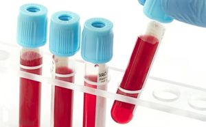 Анализ крови на энцефалит - как проводится