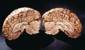 Биополярное расстройство мозга
