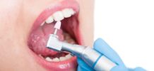 Как избавиться от зубного налета и зубного камня