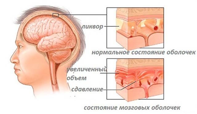 Воспаление оболочек головного мозга